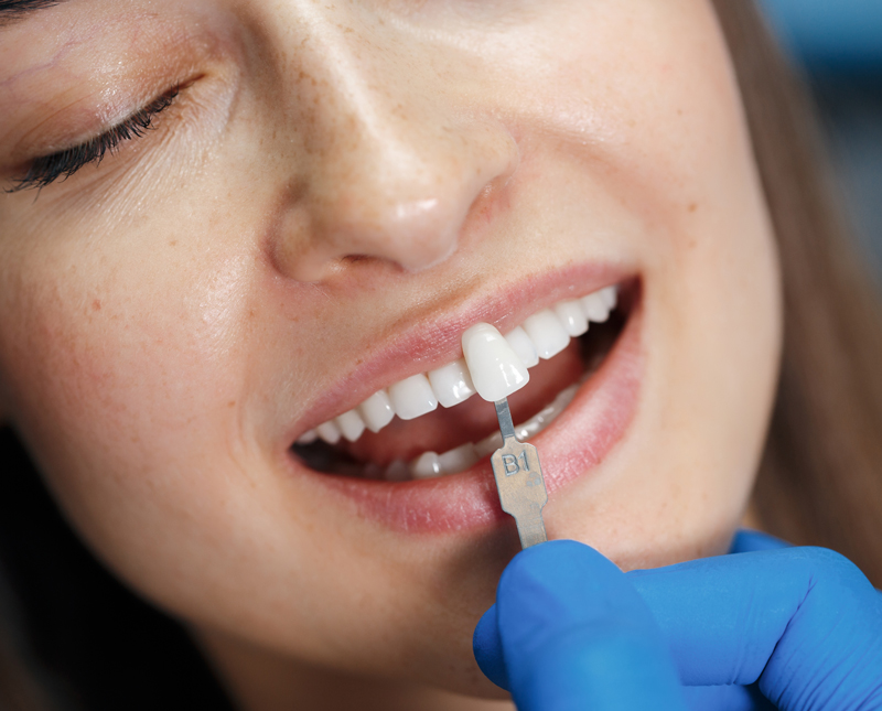 Immagine di una paziente durante il posizionamento delle faccette estetiche dentali