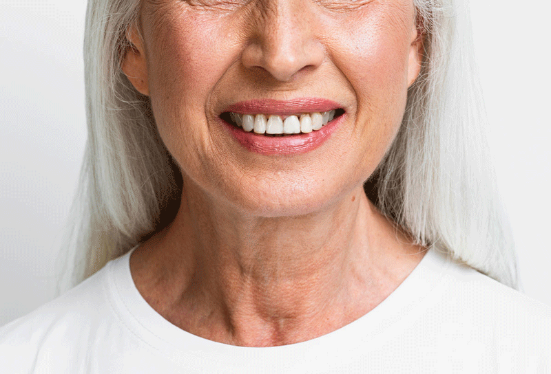 Fotografia di un sorriso con protesi dentale.